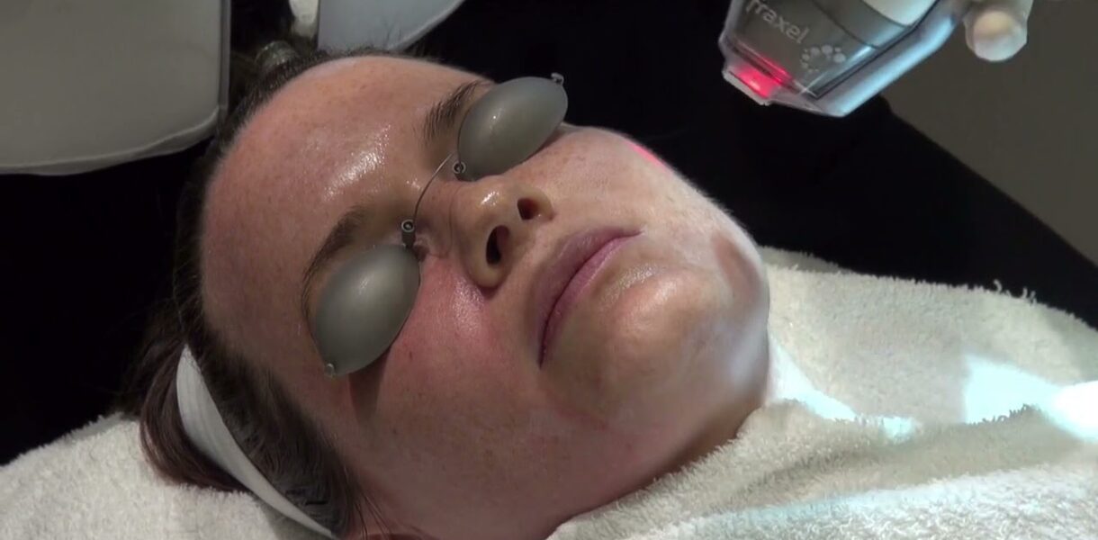 Does Fraxel Laser Stimulate Collagen Production