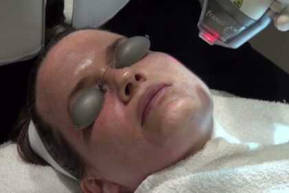 Does Fraxel Laser Stimulate Collagen Production
